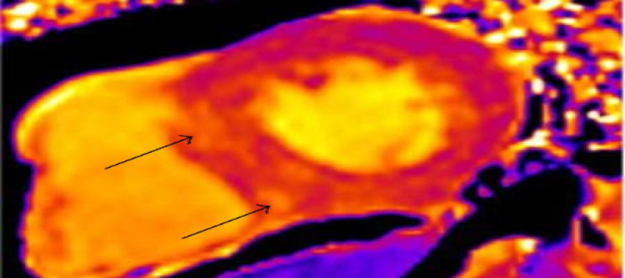 Unveiling Endomyocardial Fibrosis (EMF): Diagnosis and Evaluation image